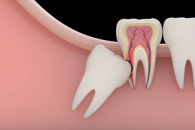 What causes Dental Impaction ?