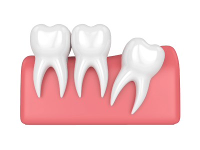 inner view of teeth impaction