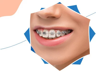 female patient with dental braces after orthodontic treatment