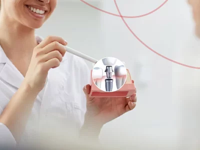 a female dentist showing keyhole implants animation at smile signature dental clinic to patients.