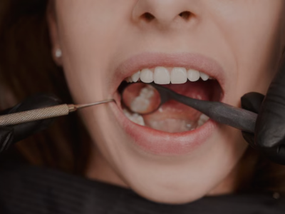Porcelain Veneers Procedure at smile signature dental clinic on female patient