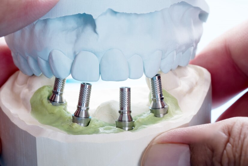 dental crown and bridge treatment in kolkata at smile signature dental clinic