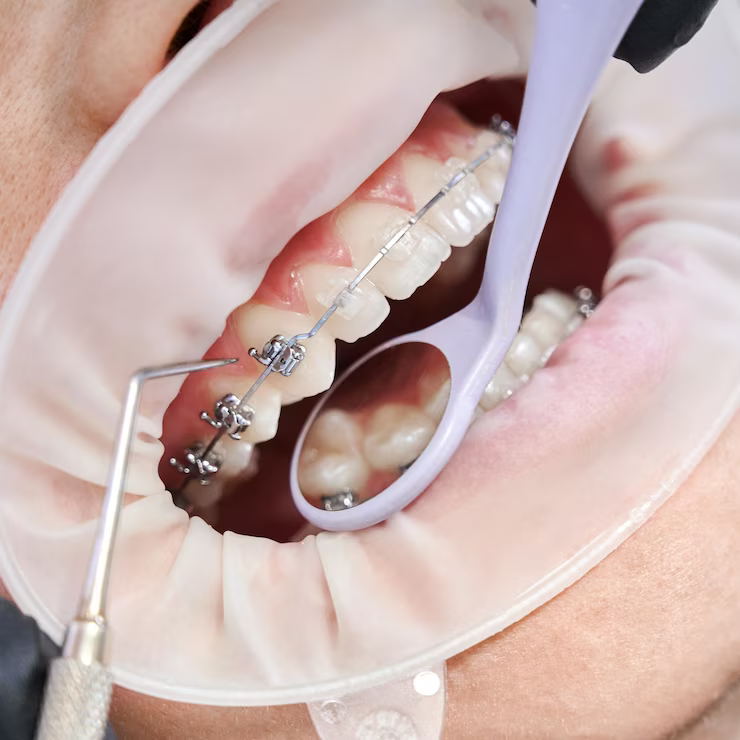 Orthdontic Treatment at our dental clinic