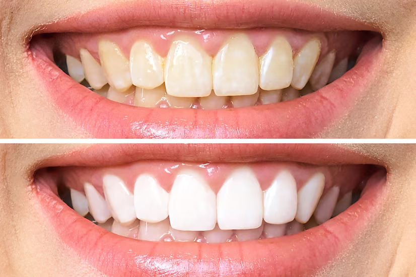 before and after teeth whitening of female patient