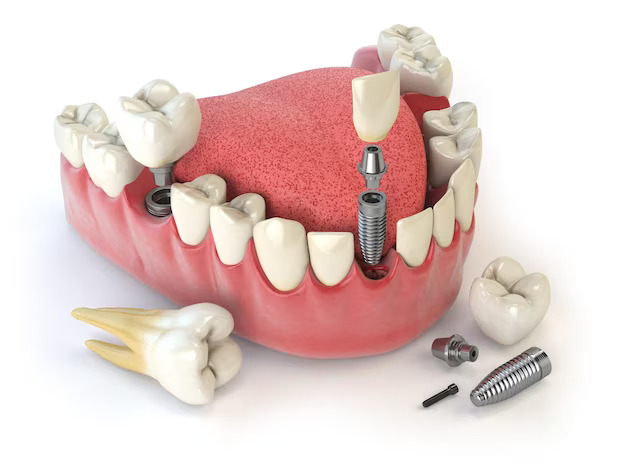 human dental implent process