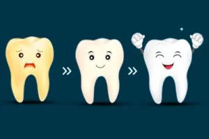 process of teeth whitening treatment at smile signature dental clinic