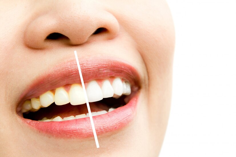 teeth whitening treatment at female patient at smile signature dental clinic