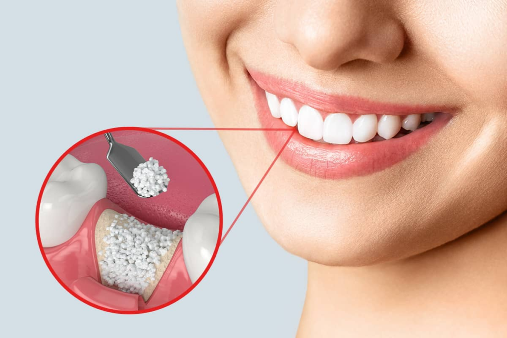 What Is Bone Grafting in Dentistry? A Complete Beginner’s Guide
